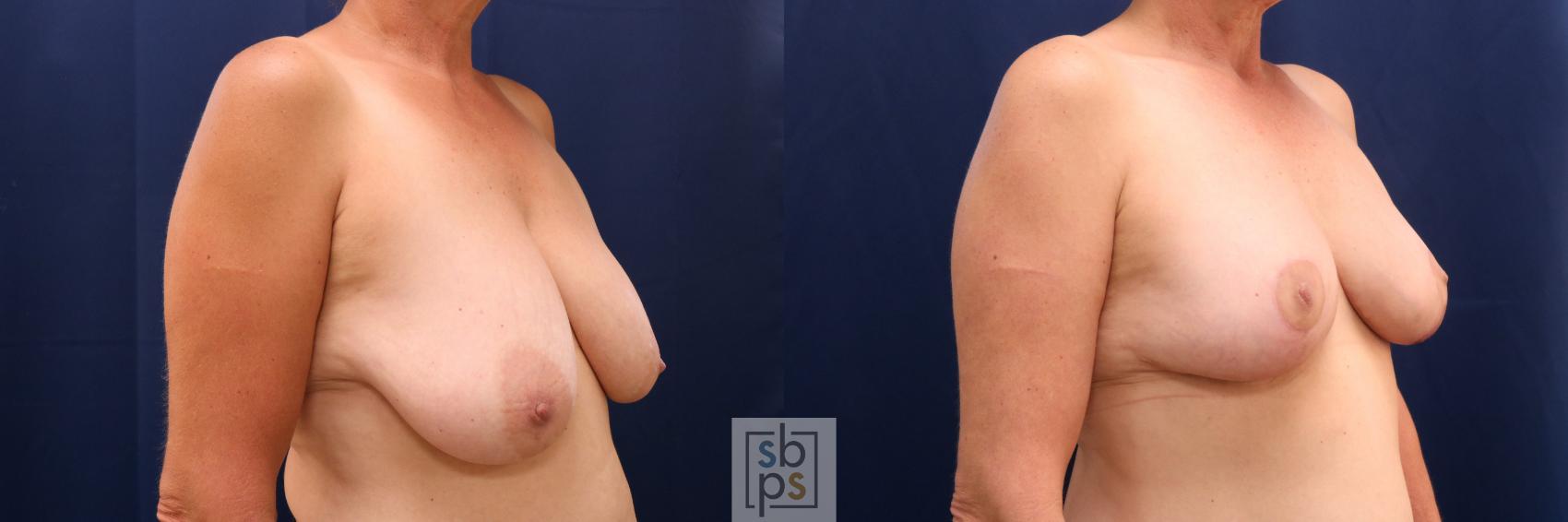 Before & After Breast Lift Case 722 Right Oblique View in Torrance & Los Angeles, CA, CA