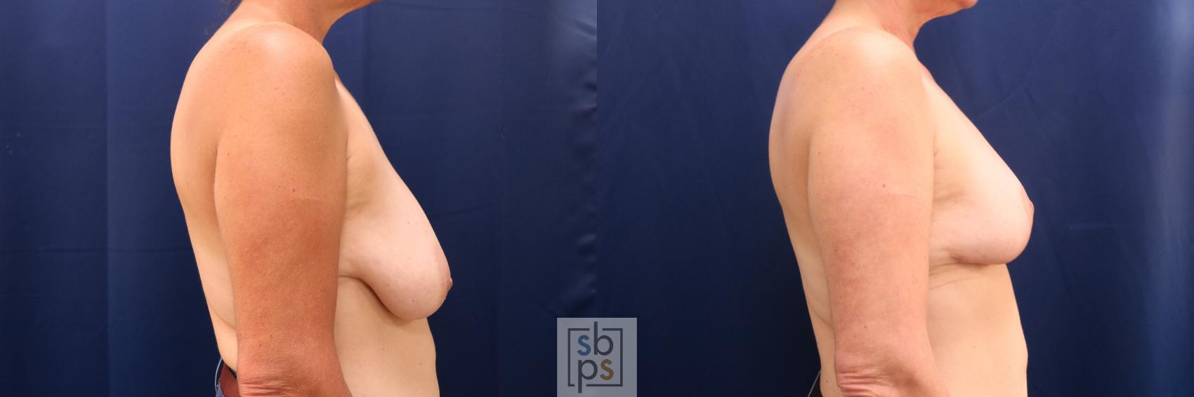 Before & After Breast Lift Case 722 Right Side View in Torrance & Los Angeles, CA, CA