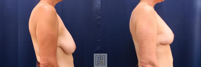 Before & After Breast Lift Case 722 Right Side View in Los Angeles & Torrance, CA, CA