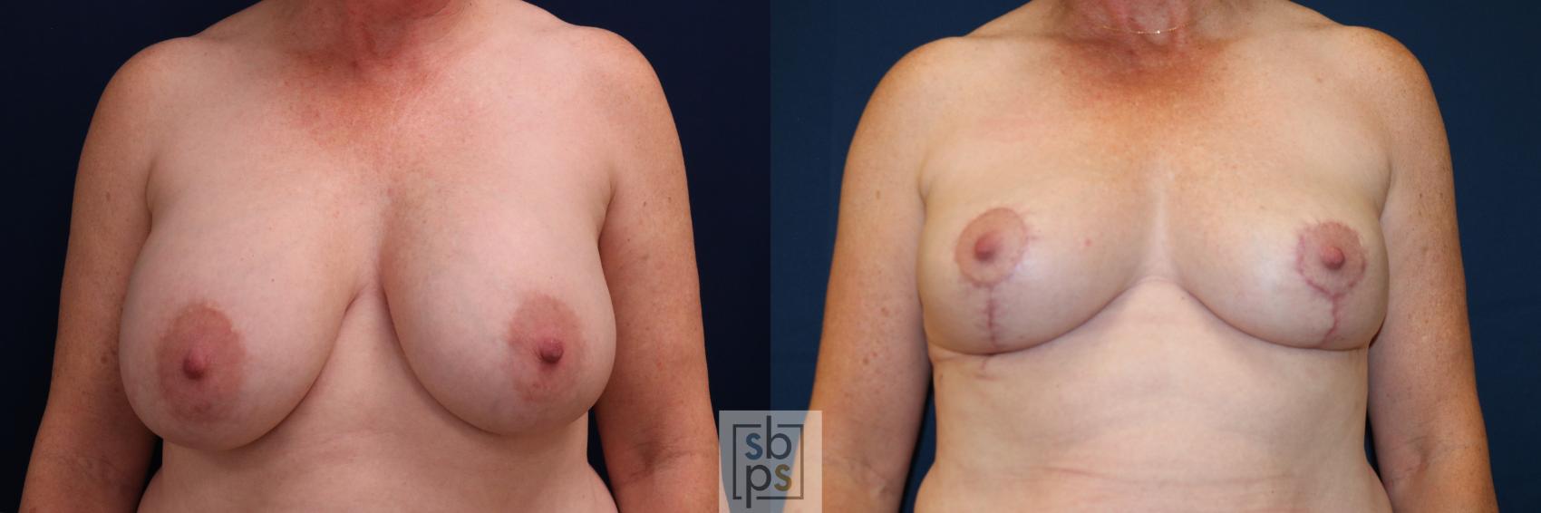 Before & After Breast Lift Case 728 Front View in Los Angeles & Torrance, CA, CA