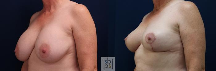 Before & After Breast Lift Case 728 Left Oblique View in Los Angeles & Torrance, CA, CA