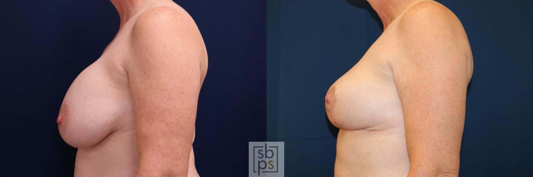 Before & After Breast Lift Case 728 Left Side View in Torrance & Los Angeles, CA, CA