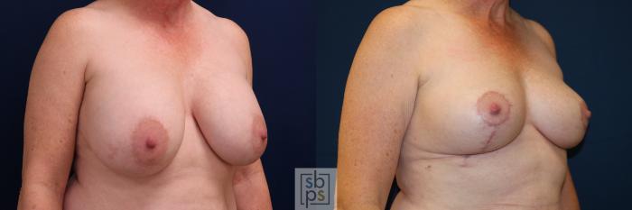 Before & After Breast Lift Case 728 Right Oblique View in Los Angeles & Torrance, CA, CA