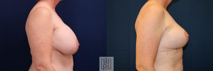 Before & After Breast Lift Case 728 Right Side View in Los Angeles & Torrance, CA, CA