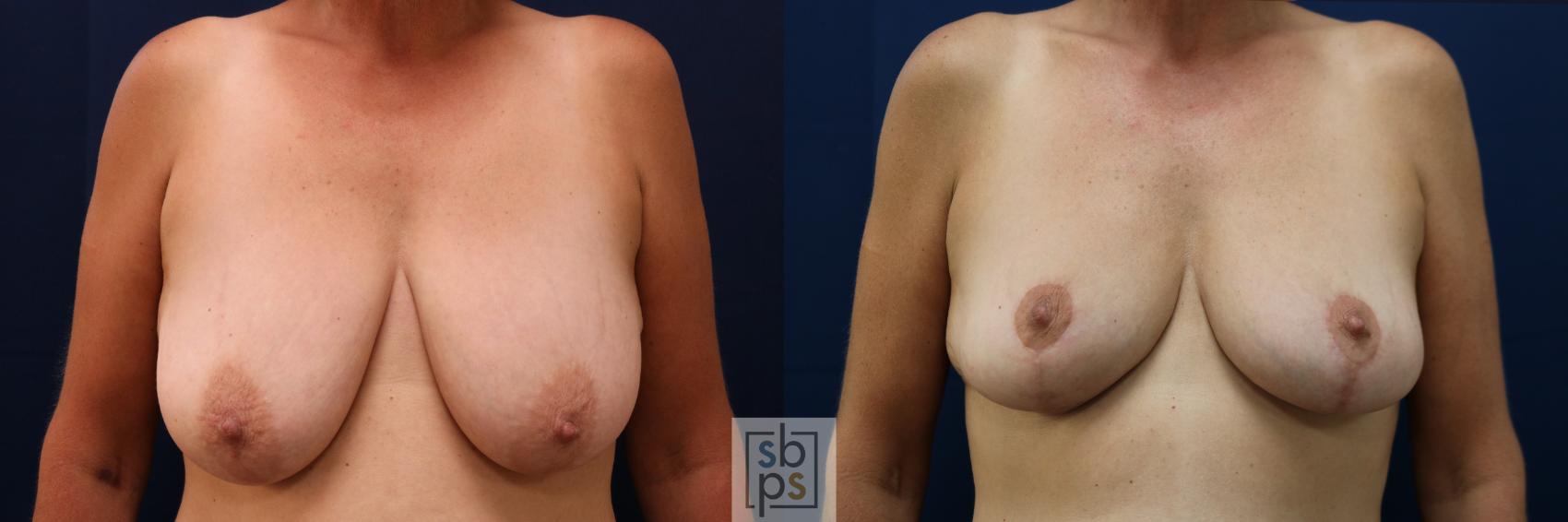 Before & After Breast Lift Case 732 Front View in Los Angeles & Torrance, CA, CA