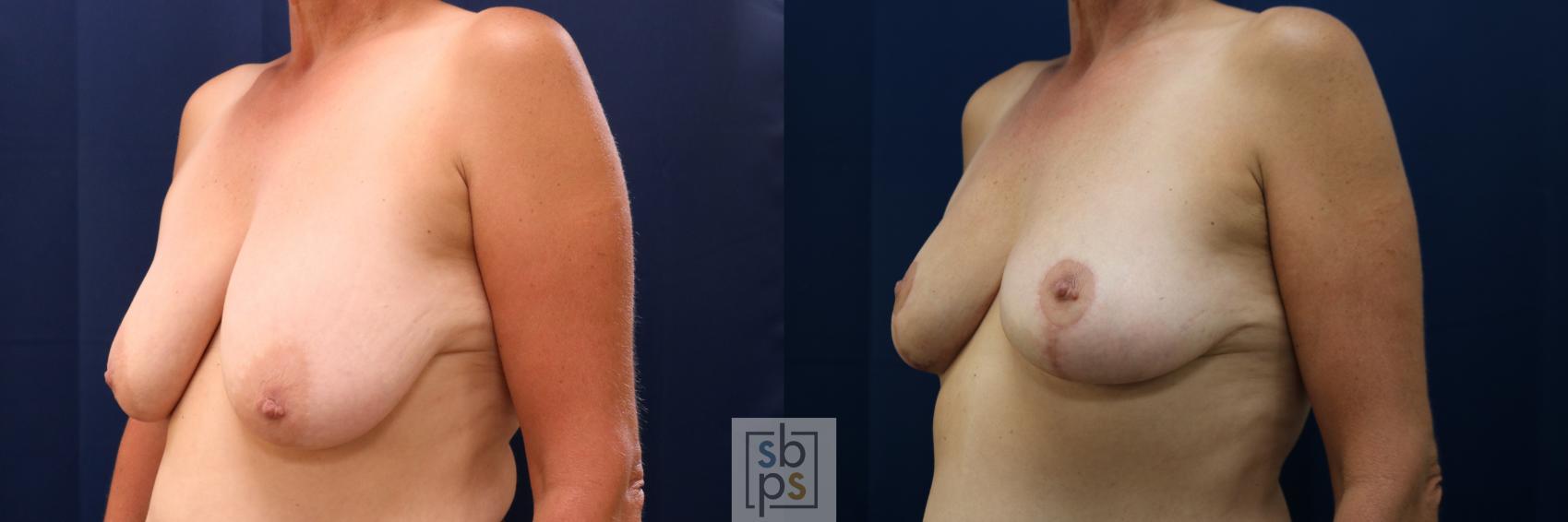 Before & After Breast Lift Case 732 Left Oblique View in Torrance & Los Angeles, CA, CA