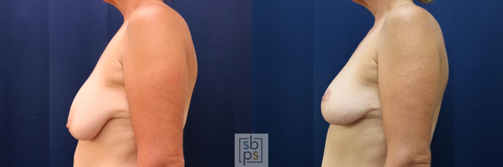 Before & After Breast Lift Case 732 Left Side View in Torrance & Los Angeles, CA, CA