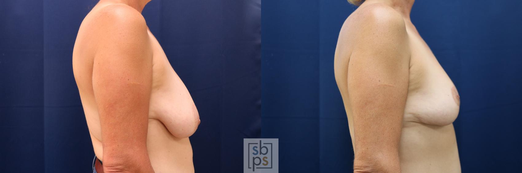 Before & After Breast Lift Case 732 Right Side View in Torrance & Los Angeles, CA, CA