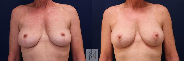 Before & After Breast Lift Case 760 Front View in Los Angeles, Torrance & Long Beach, CA