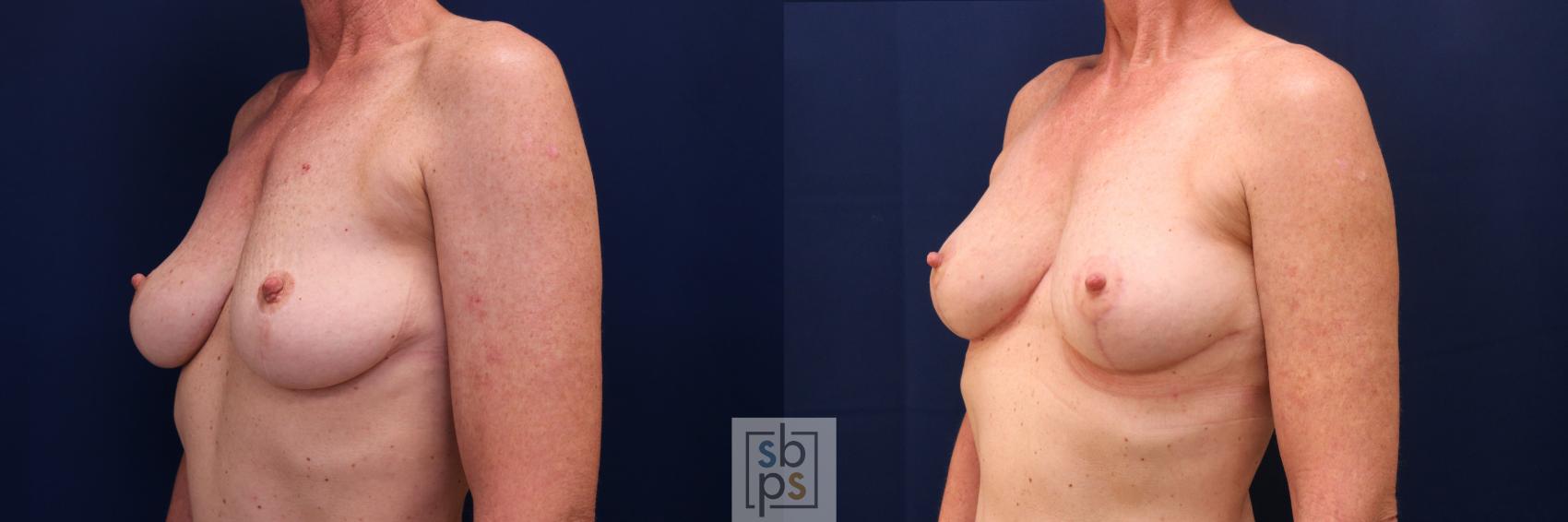 Before & After Breast Lift Case 760 Left Oblique View in Los Angeles, Torrance & Long Beach, CA