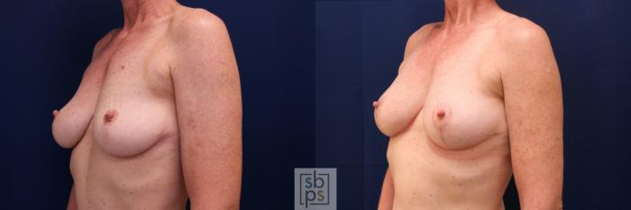 Before & After Breast Lift Case 760 Left Oblique View in Los Angeles, Torrance & Long Beach, CA