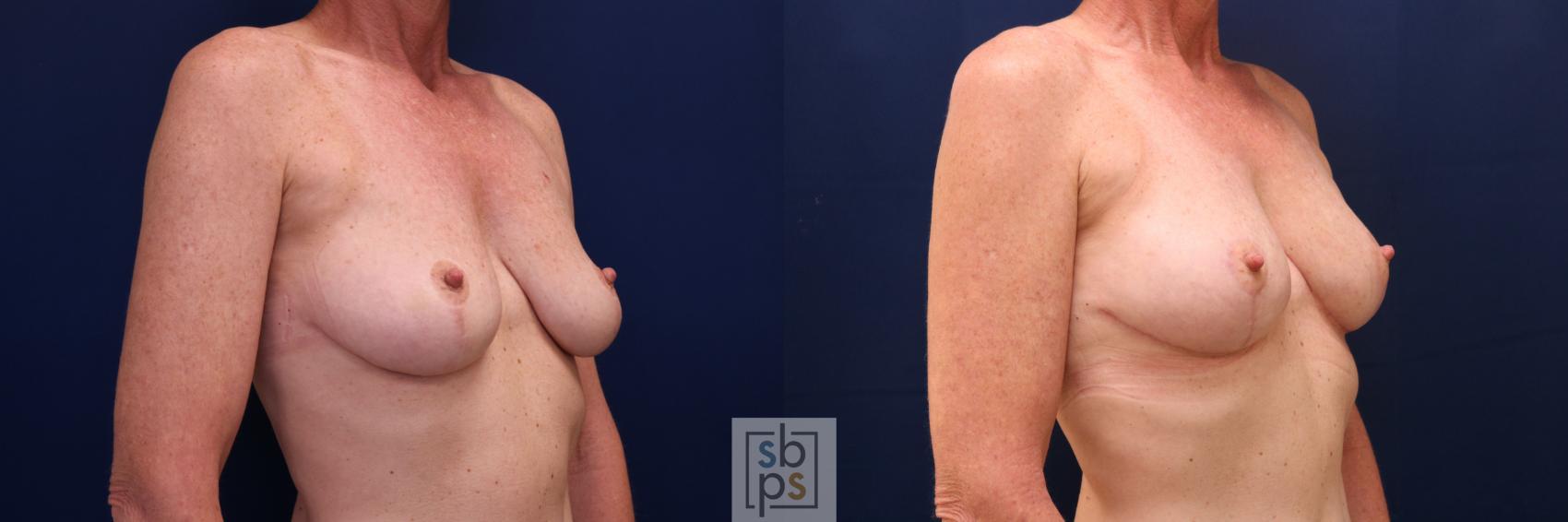 Before & After Breast Lift Case 760 Right Oblique View in Los Angeles, Torrance & Long Beach, CA
