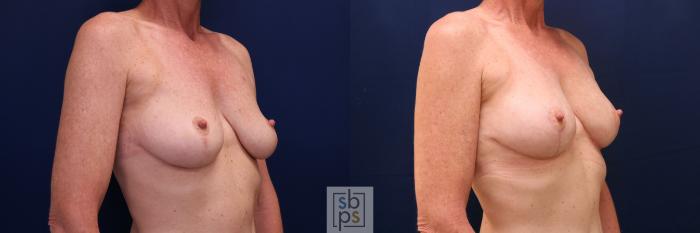 Before & After Breast Lift Case 760 Right Oblique View in Los Angeles, Torrance & Long Beach, CA