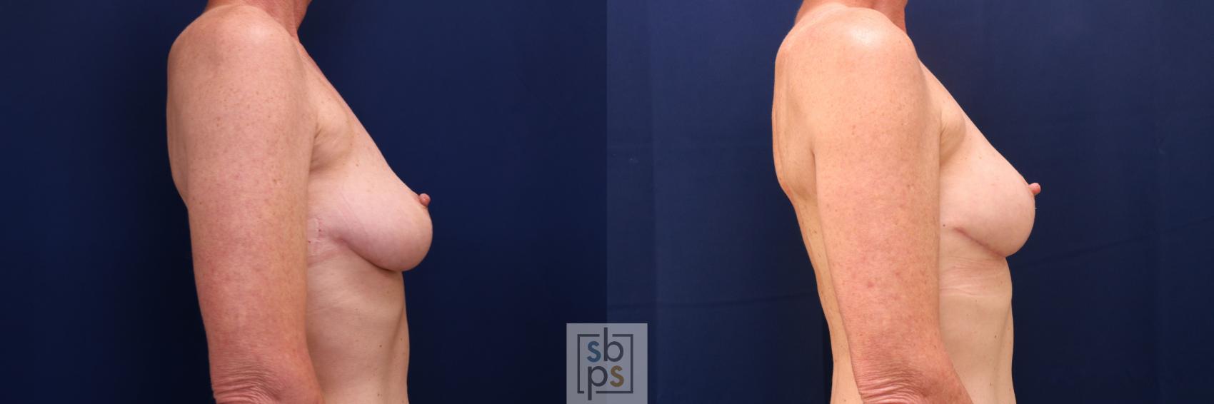 Before & After Breast Lift Case 760 Right Side View in Los Angeles, Torrance & Long Beach, CA