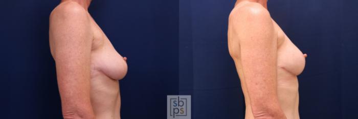 Before & After Breast Lift Case 760 Right Side View in Los Angeles, Torrance & Long Beach, CA