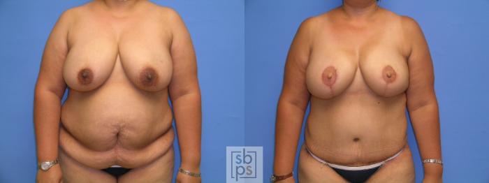 Before & After Breast Reconstruction Case 105 View #1 View in Torrance, CA