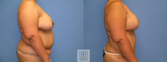 Before & After Breast Reconstruction Case 105 View #2 View in Torrance, CA