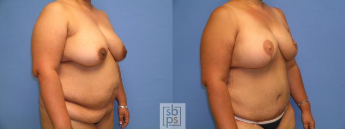 Before & After Breast Reconstruction Case 105 View #3 View in Torrance, CA