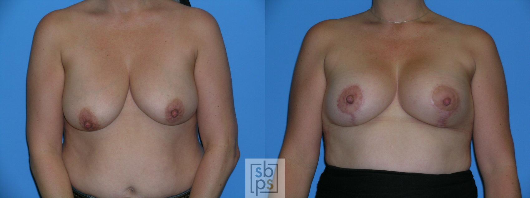 Before & After Breast Reconstruction Case 114 View #1 View in Torrance, CA