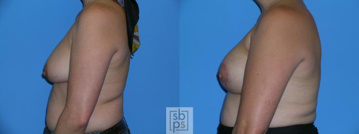 Before & After Breast Reconstruction Case 114 View #3 View in Torrance, CA