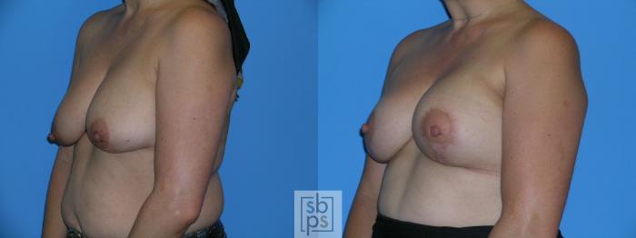 Before & After Breast Reconstruction Case 114 View #4 View in Torrance, CA