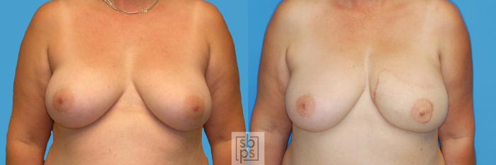 Before & After Breast Reconstruction Case 157 View #1 View in Torrance, CA