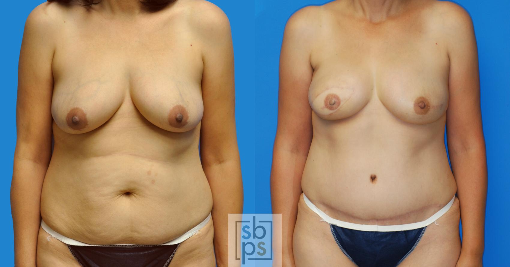 Before & After Breast Reconstruction Case 159 View #1 View in Torrance, CA