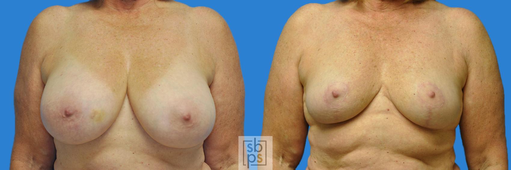 Before & After Breast Reconstruction Case 160 View #1 View in Torrance, CA