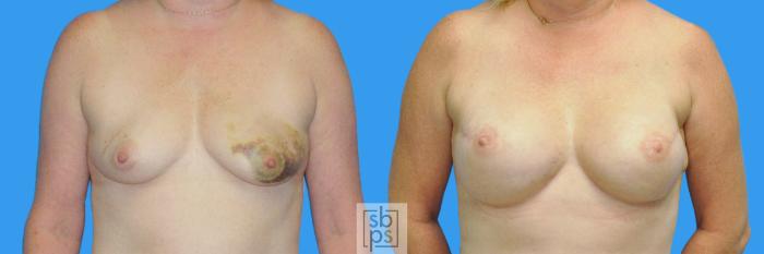 Before & After Breast Reconstruction Case 161 View #1 View in Torrance, CA