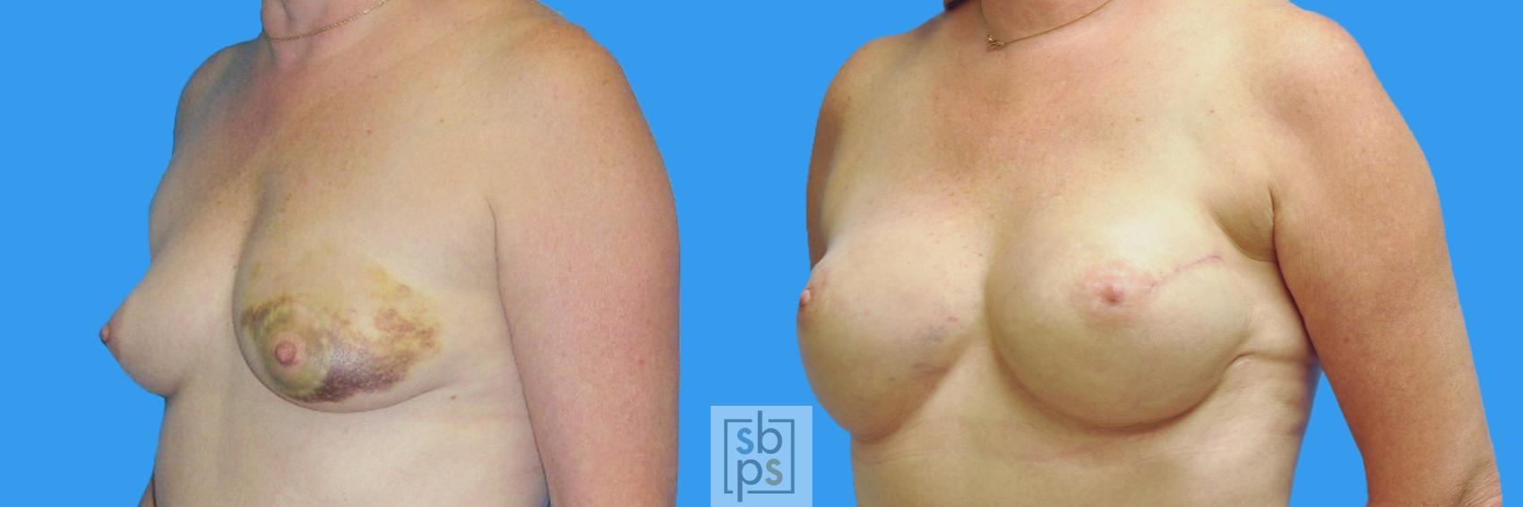 Before & After Breast Reconstruction Case 161 View #2 View in Torrance & Los Angeles, CA, CA