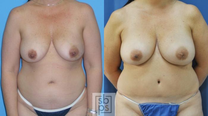 Before & After Breast Reconstruction Case 173 View #1 View in Torrance, CA