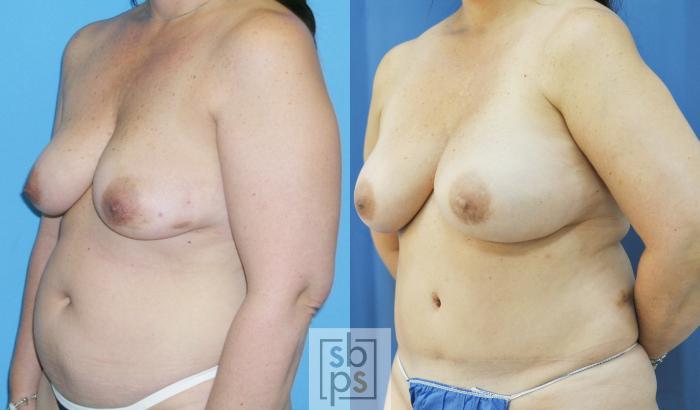 Before & After Breast Reconstruction Case 173 View #2 View in Torrance, CA