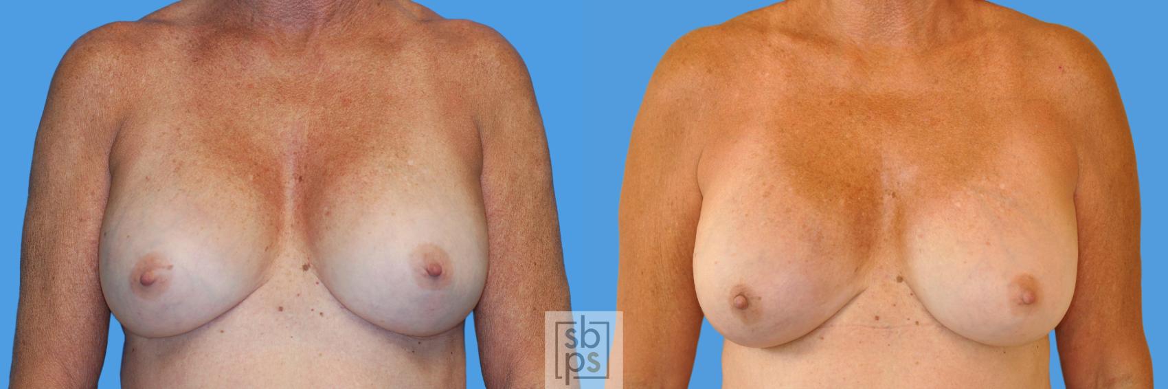 Before & After Breast Reconstruction Case 175 View #1 View in Torrance, CA