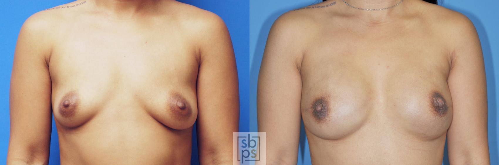 Before & After Breast Reconstruction Case 176 View #1 View in Torrance, CA