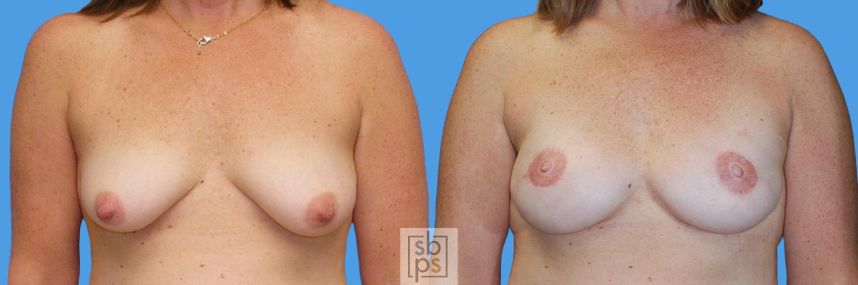 Before & After Breast Reconstruction Case 179 View #1 View in Torrance, CA
