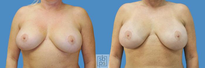 Before & After Breast Reconstruction Case 192 View #1 View in Torrance, CA