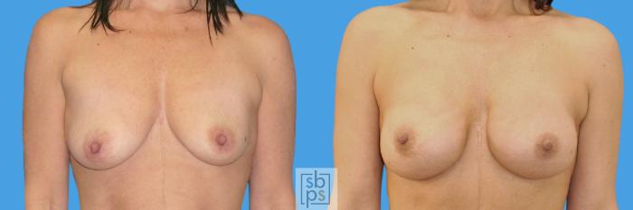 Before & After Breast Reconstruction Case 209 View #1 View in Torrance, CA
