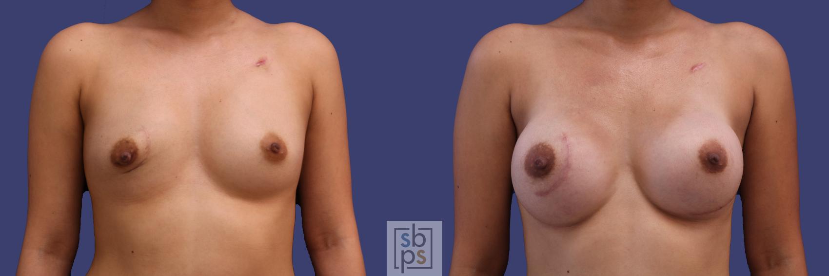 Before & After Breast Reconstruction Case 254 View #1 View in Torrance, CA