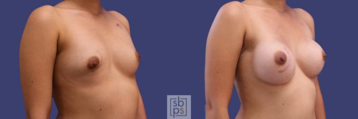 Before & After Breast Reconstruction Case 254 View #2 View in Torrance, CA