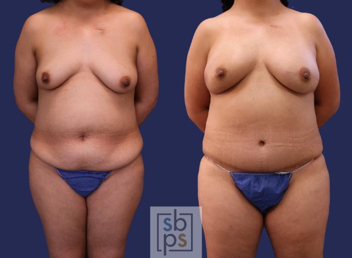 Before & After Breast Reconstruction Case 265 View #1 View in Torrance, CA