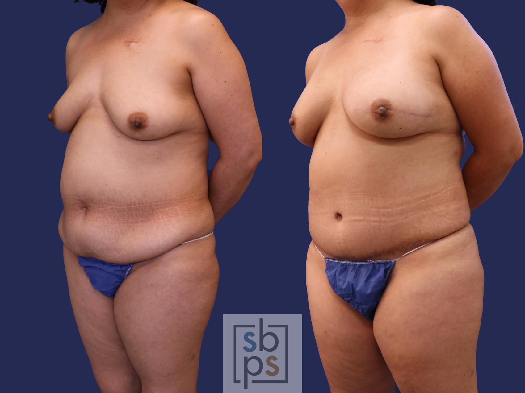 Before & After Breast Reconstruction Case 265 View #2 View in Torrance & Los Angeles, CA, CA