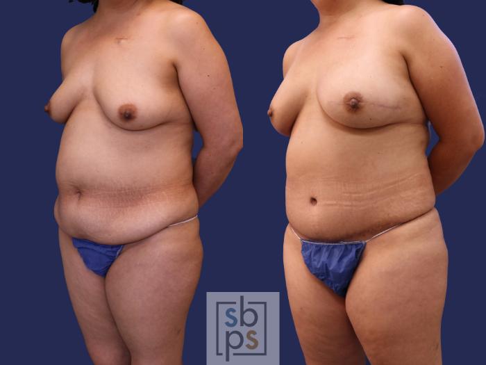 Before & After Breast Reconstruction Case 265 View #2 View in Torrance, CA