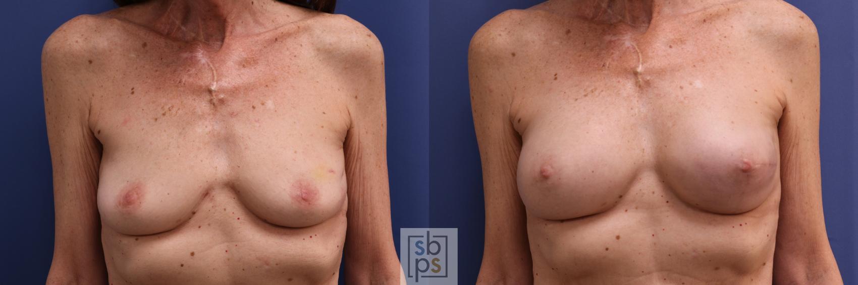 Before & After Breast Reconstruction Case 273 View #1 View in Torrance, CA