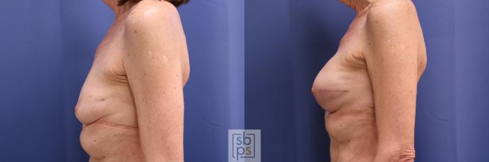 Before & After Breast Augmentation Case 273 View #2 View in Torrance, CA