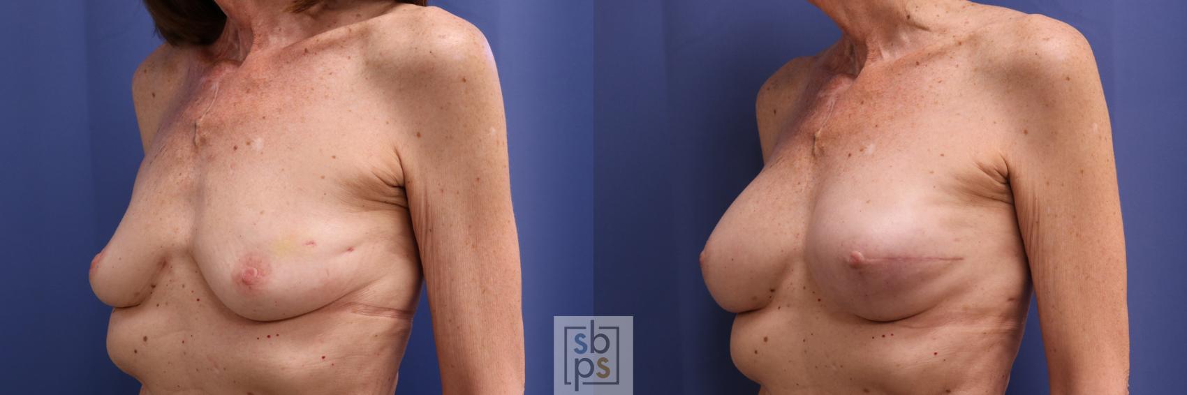 Before & After Breast Reconstruction Case 273 View #3 View in Torrance, CA