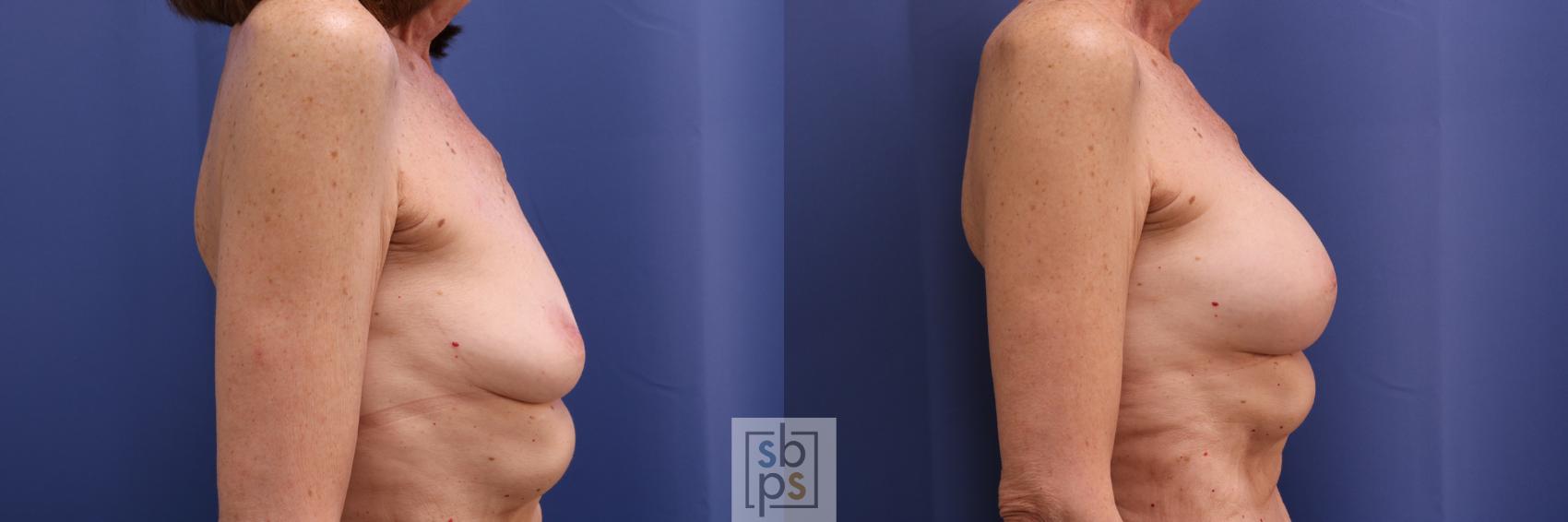 Before & After Breast Reconstruction Case 273 View #4 View in Torrance, CA