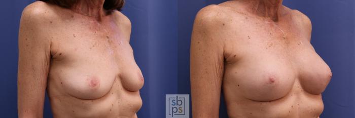 Before & After Breast Augmentation Case 273 View #5 View in Torrance, CA