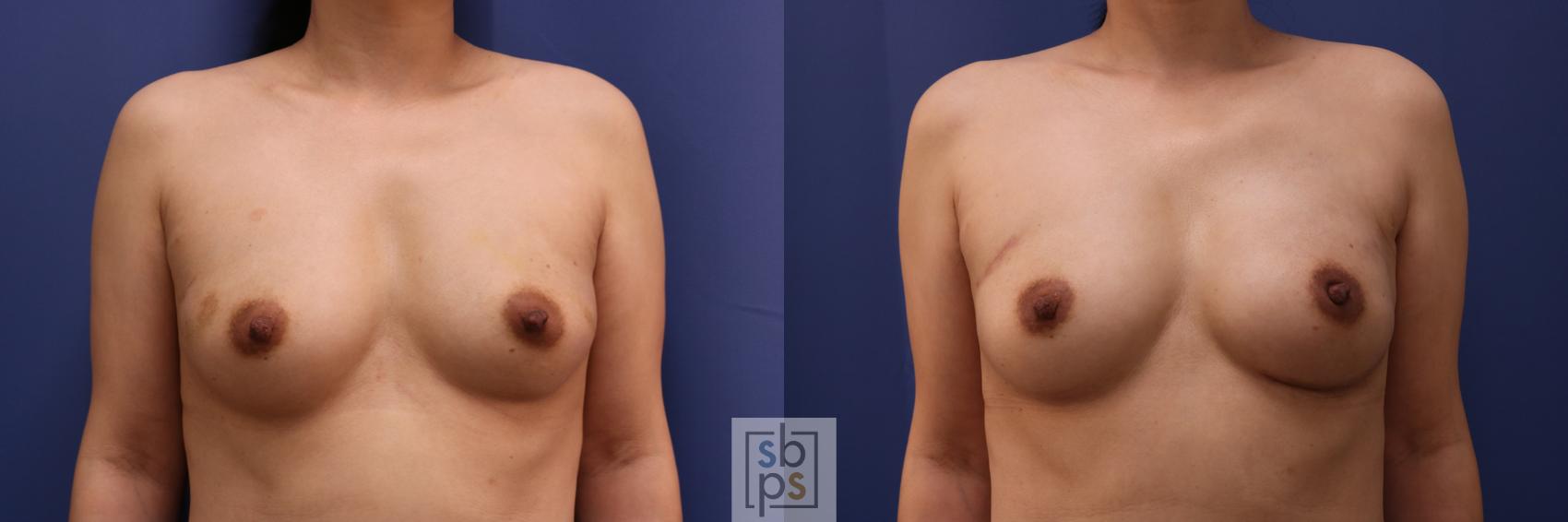 Before & After Breast Reconstruction Case 275 View #1 View in Torrance, CA