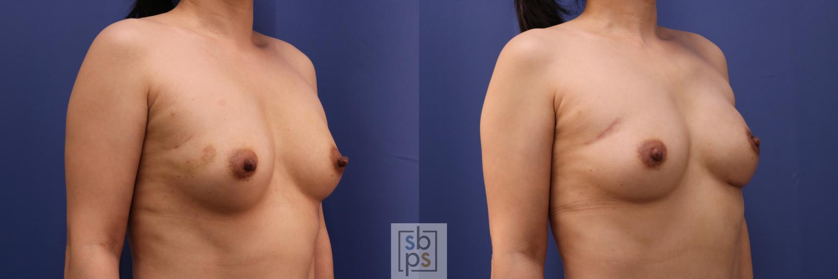 Before & After Breast Reconstruction Case 275 View #2 View in Torrance & Los Angeles, CA, CA