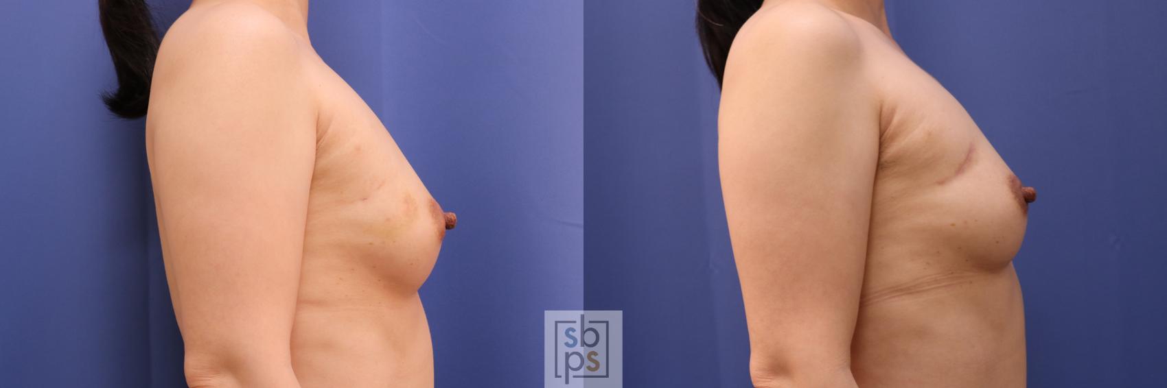 Before & After Breast Reconstruction Case 275 View #3 View in Torrance & Los Angeles, CA, CA